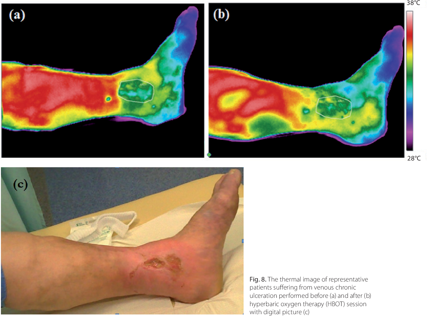 The Benefits of Hyperbaric Oxygen Therapy for Wound Healing