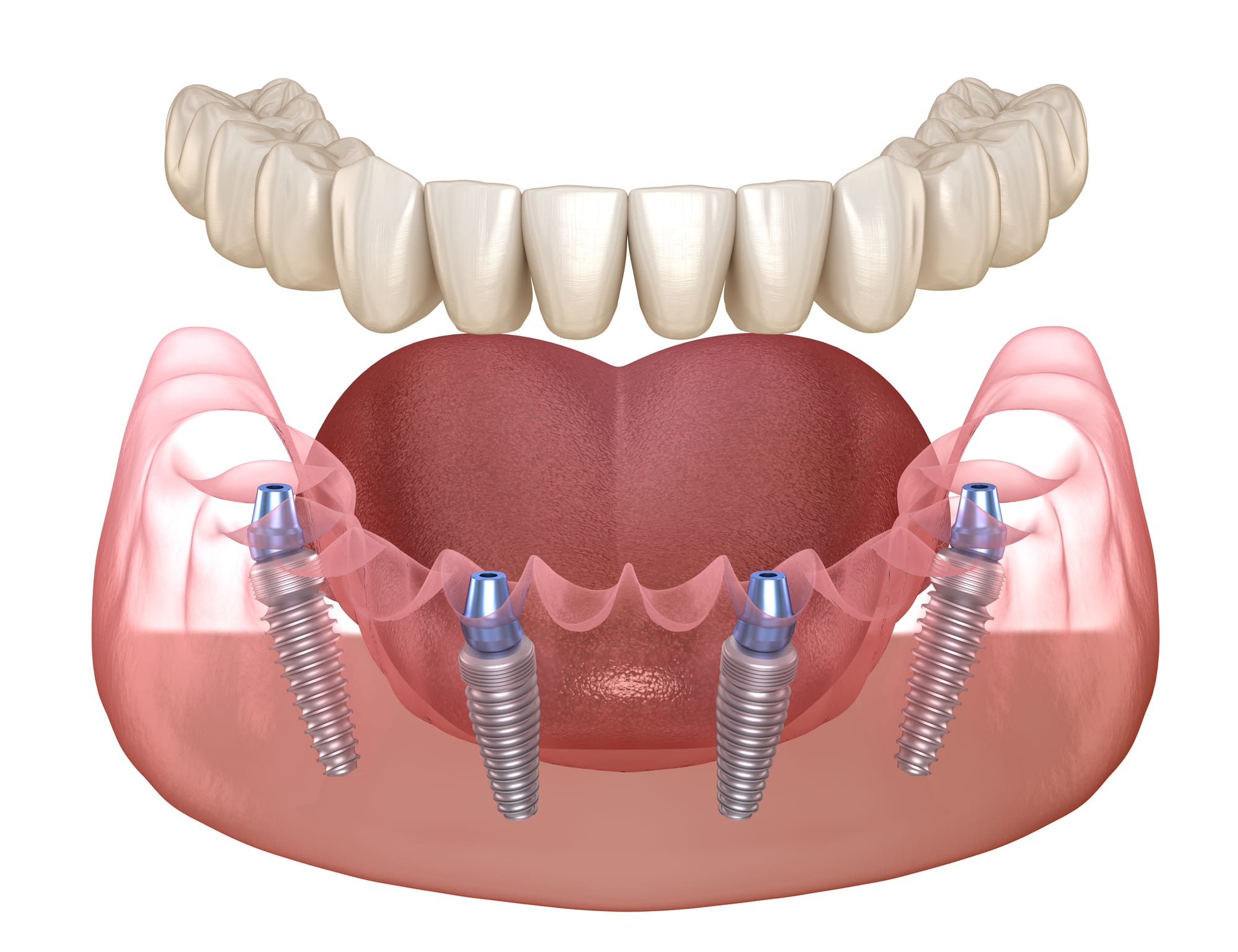 10 Benefícios da Técnica 'All on Four' para Implantes Dentários