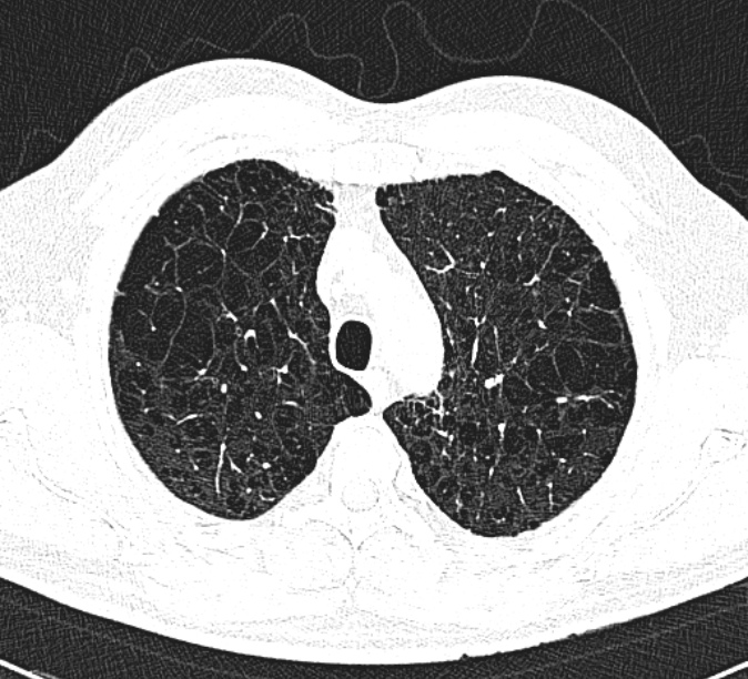 ct scan of lungs with COPD