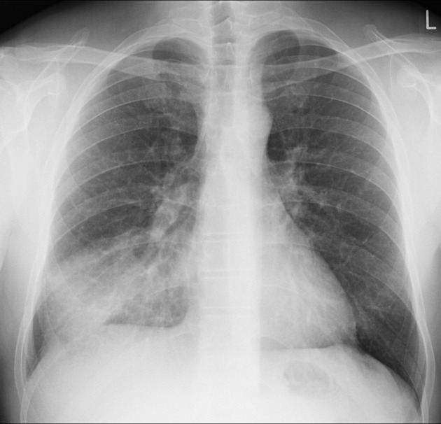 chest xray showing pneumonia