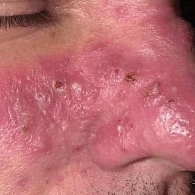 PERMANENT CURE FOR HERPES