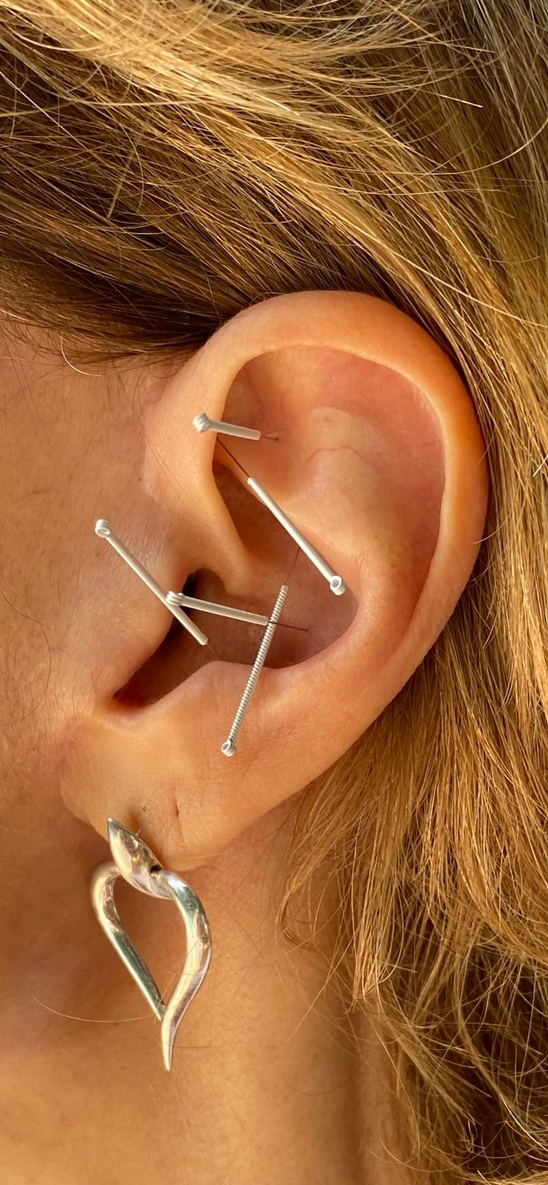 Auricular (Ear) Acupuncture