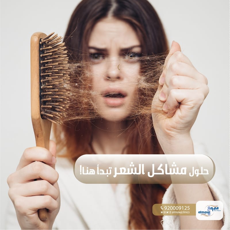 مميزات إكسوسمارت (Exosmart): الحل المبتكر لعلاج تساقط الشعر والصلع الوراثي في عيادات الموج