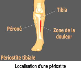 Périostite tibial traitement