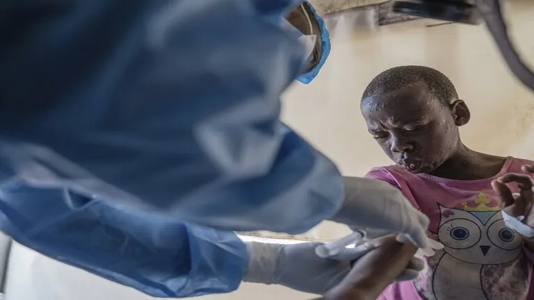 الكونغو تعلن تسجيل أكثر من ألف إصابة جديدة بجدري القرود في أسبوع والسلطات الإفريقية تطلب لقاحات