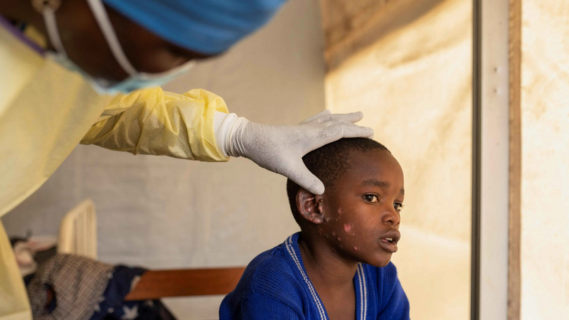 مع ترقب حالة طوارئ عامة.. متحور "جدري القردة" يثير قلق العالم