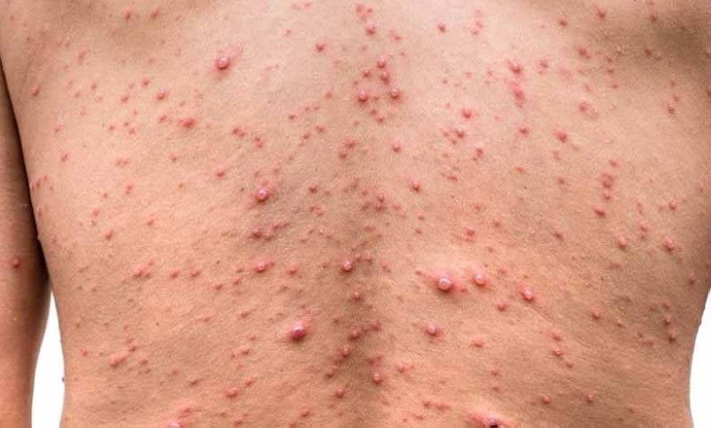 منظمة الصحة العالمية تعلن "جدري القردة" حالة طارئة صحية عالميًّا