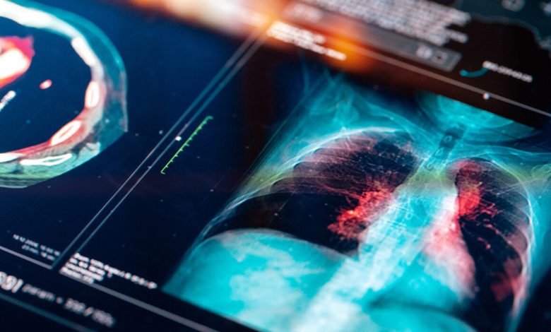 فريق طبي يكشف تهديدا صامتا قد يزيد من خطر إصابة غير المدخنين بسرطان الرئة