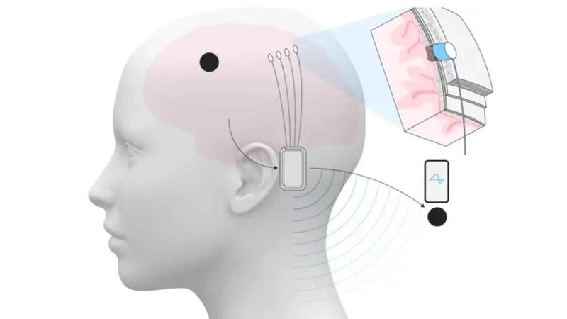 زراعة الشرائح الدماغية.. ماذا يخطط ماسك للبشرية في 2025؟