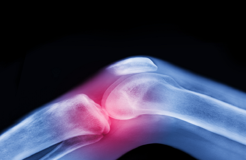 العلاج الأقوى لآلام المفاصل قبل اللجوء إلى الأدوية والجراحة