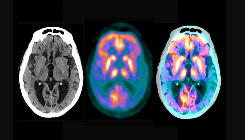 دراسة: جين واحد وراء الغالبية العظمى من حالات الزهايمر