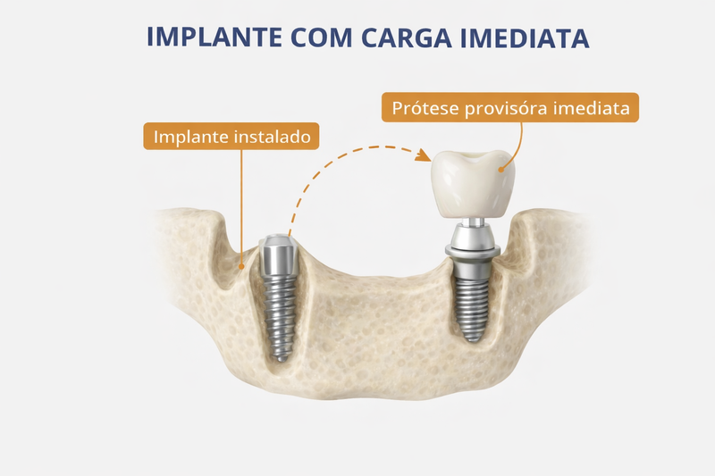 ⚡ IMPLANTE COM CARGA IMEDIATA