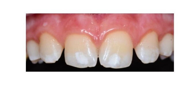 Tecniche di intervento e gestione clinica delle discromie dentali: utilizzo di microabrasione e d’infiltrazione di resina come trattamento combinato