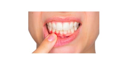 Efficacia di olio ozonizzato e clorexidina digluconato allo 0,12% a confronto come coadiuvanti nella terapia parodontale non chirurgica