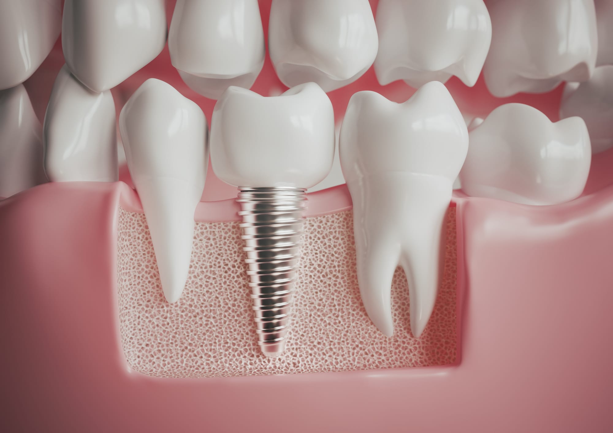 Implant therapy