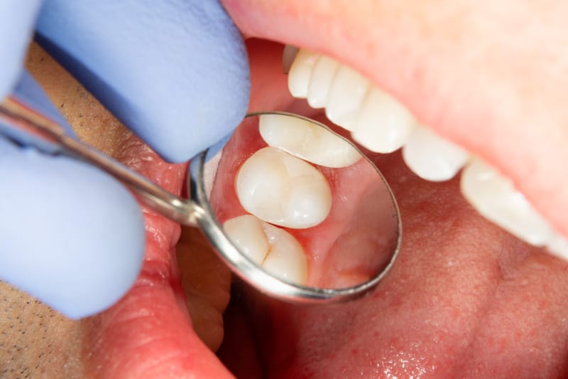 Composite Fillings