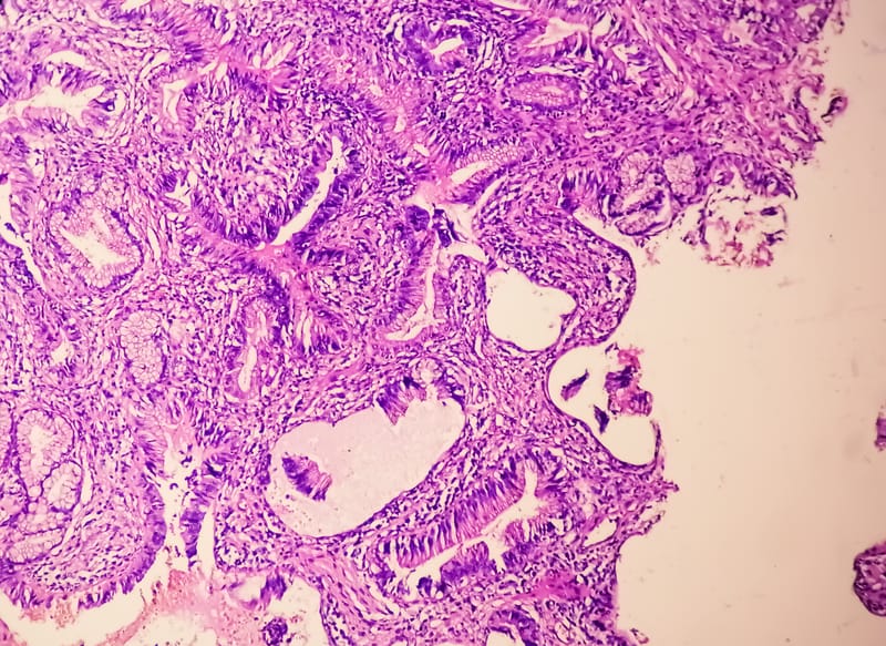 Tracking Genomic and Transcriptomic Changes in Metastatic Prostate Cancer through Circulating Tumor Extracellular Vesicles