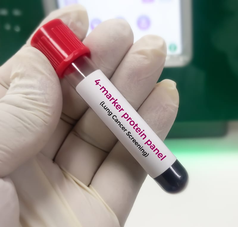 FDA Approves First Blood-Based Diagnostic Test for Alzheimer’s Disease