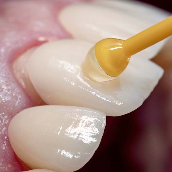 ¡Innovación en Ortho Dental Studio! Nueva cabina de fotocurado para carillas