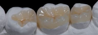 beneficios de la biomimetica en ortho dental studio valencia