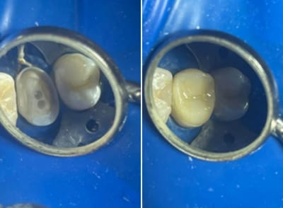 restaurar tus dientes imitando lo natural