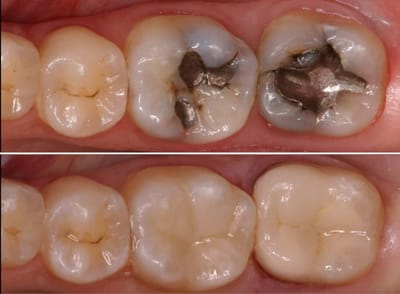 restaurar tus dientes imitando lo natural