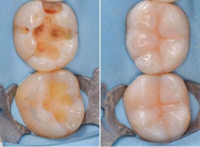 restaurar tus dientes imitando lo natural