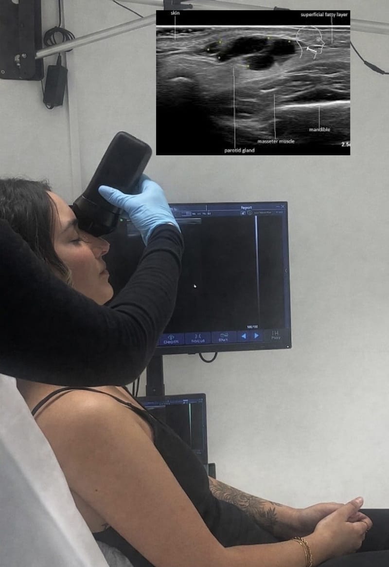 FaceMap™ Ultrasound Filler Assessment & Dissolving