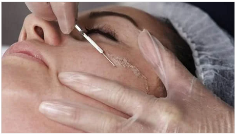 Dermaplaning