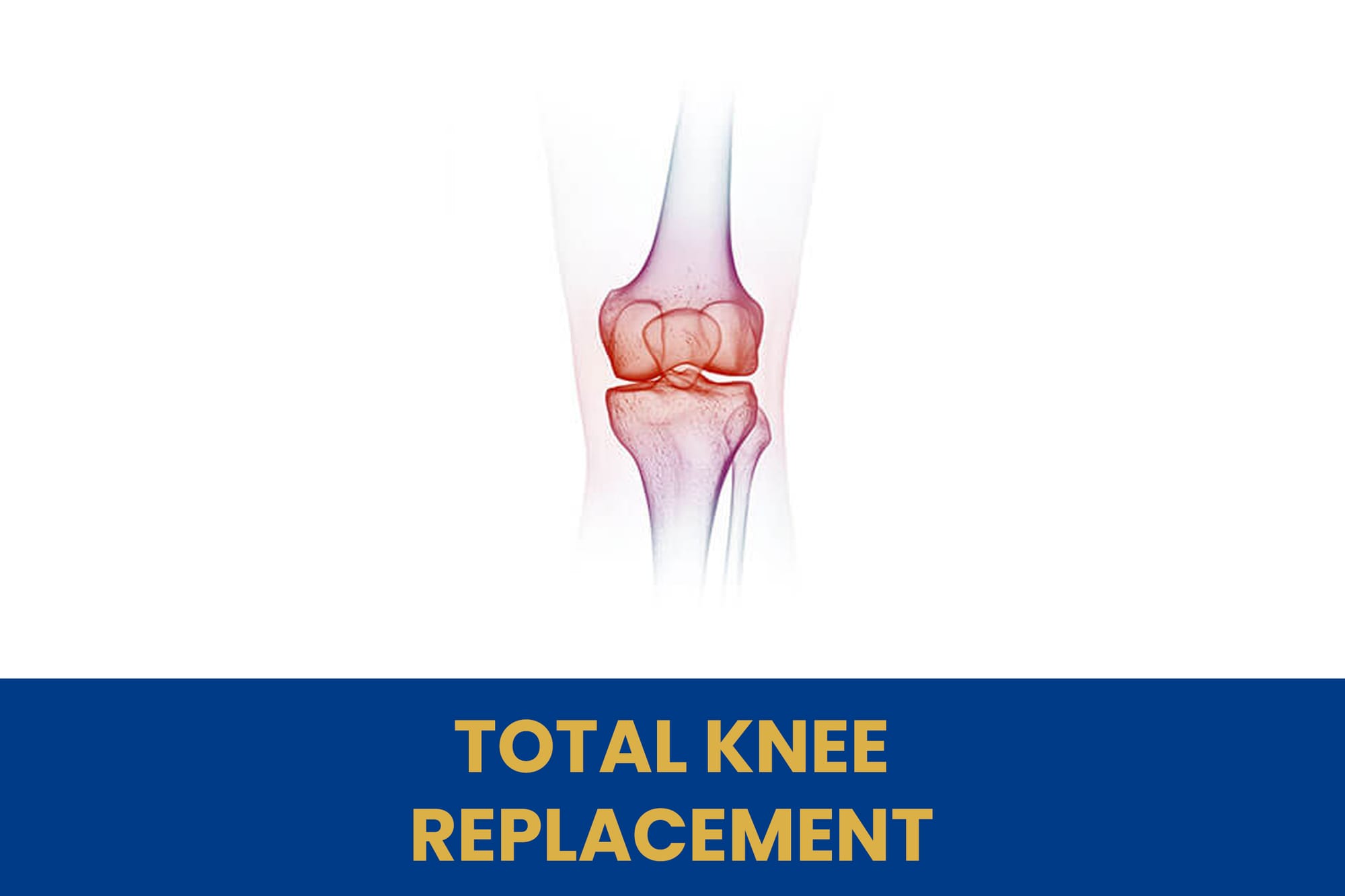 TOTAL KNEE REPLACEMENT