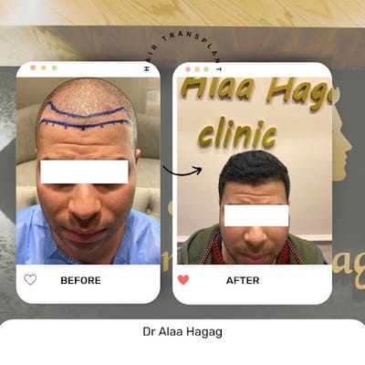 علاج تساقط الشعر