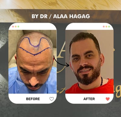 زراعة الشعر في مصر والسعودية