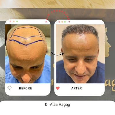 أحدث طرق زراعة الشعر