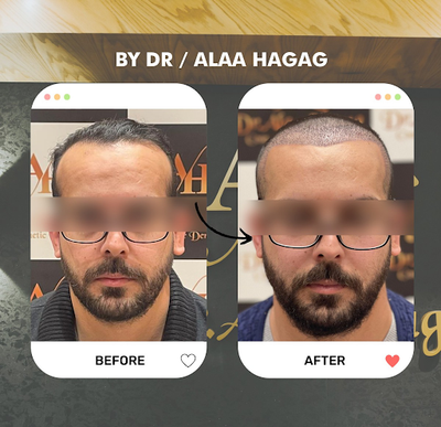 مراكز زراعة الشعر فى مصر