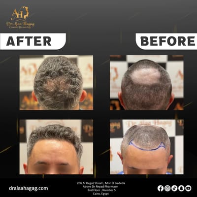 تقنيات للتجميل وزراعة الشعر