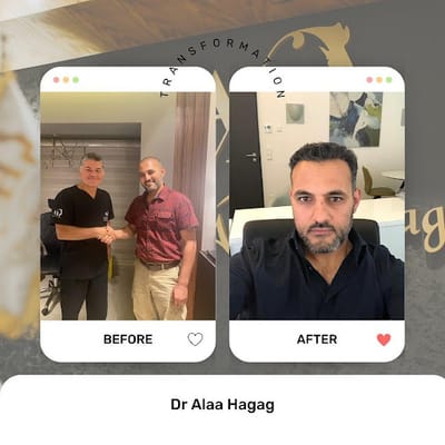 افضل دكتور زراعة شعر في مصر