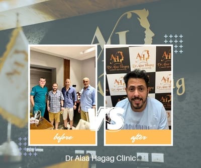 انواع عمليات زراعة الشعر