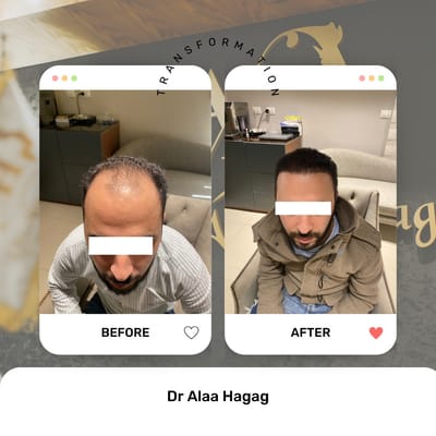 أفضل مركز زراعة شعر