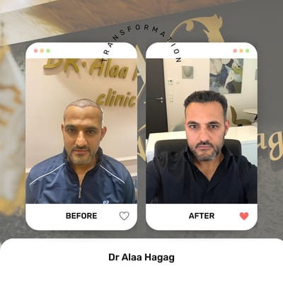 تقنيات زراعة الشعر