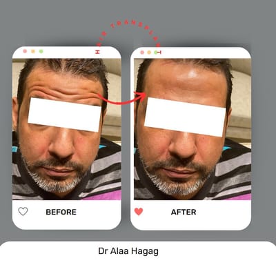 زرع الشعر فى مصر