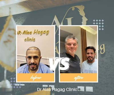 زراعة الشعر