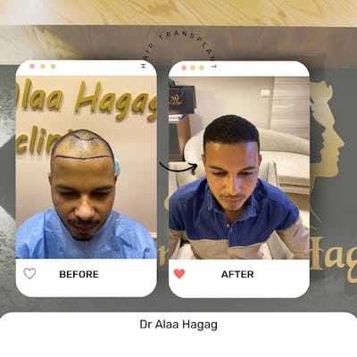 أفضل مراكز زراعة الشعر في العالم