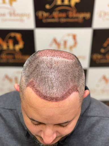 افضل دكتور زراعة شعر في مصر