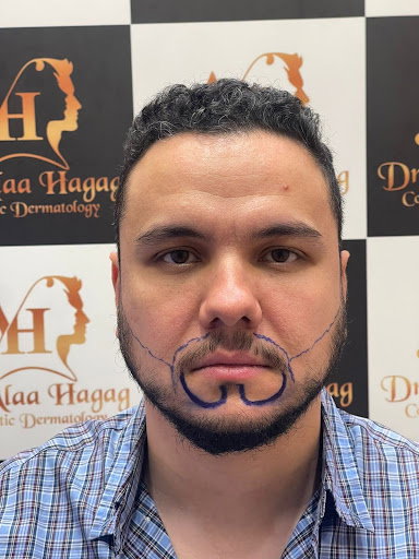 زراعة الذقن في الرياض