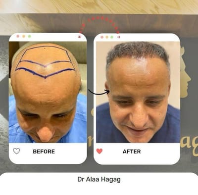 مركز زرع الشعر في مصر