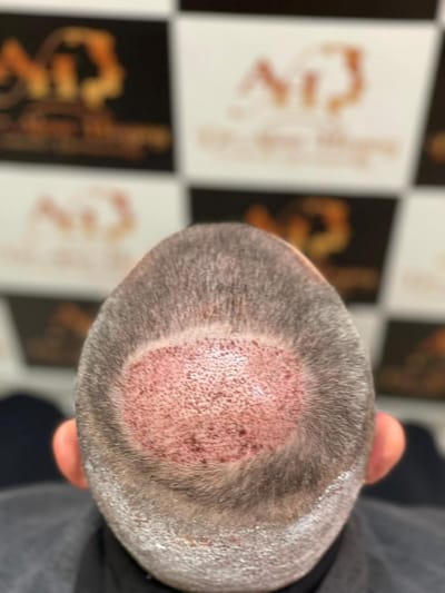 نتائج زراعة الشعر في السعودية