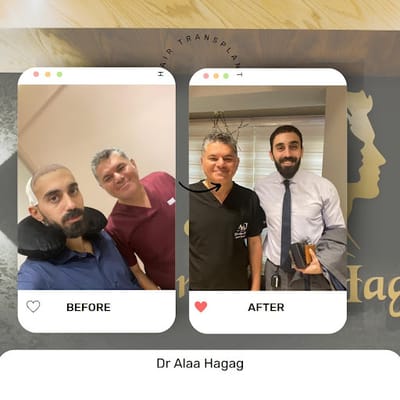 افضل دكتور زراعة شعرفي مصر