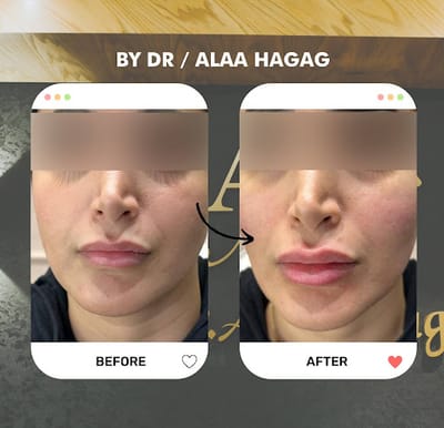 افضل دكتور حقن فيلر في مصر