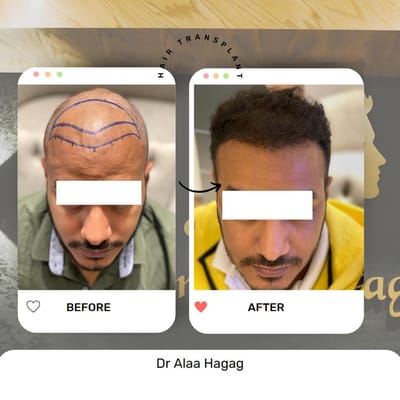 مراكز زراعة الشعر