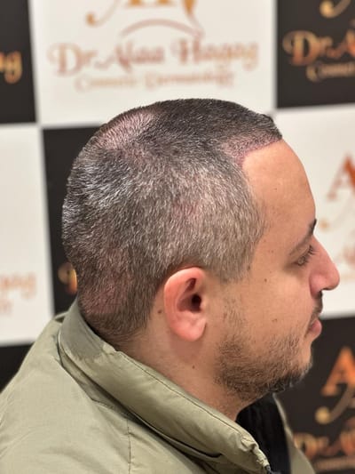 زراعة الشعر